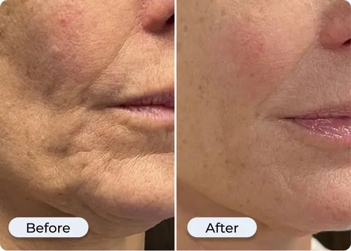 Before and after photos of a woman's lower face used in Glamory's marketing