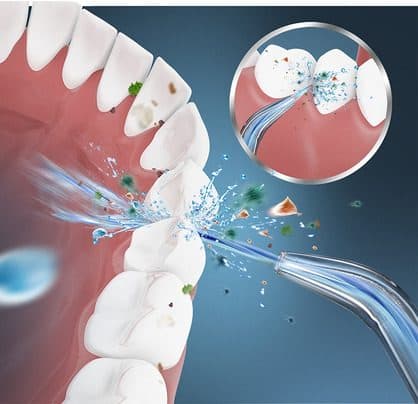 Illustration of a water jet from a flosser nozzle blasting debris from between lower teeth, with a close-up inset
