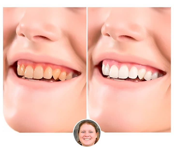 Seller's before and after image of a smile with yellow teeth on one side and white teeth on the other