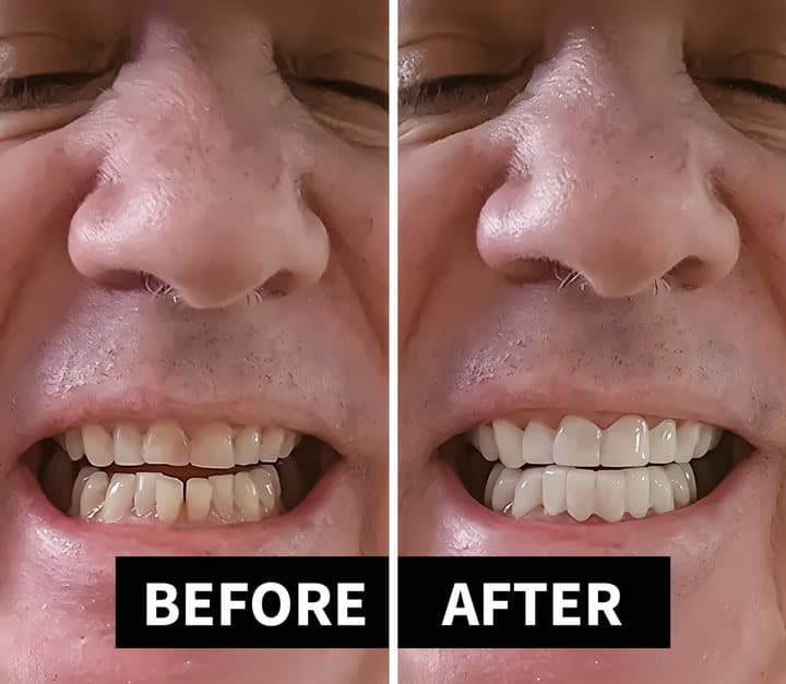 Seller's before and after photos of a man's smile with stained teeth and then with veneers