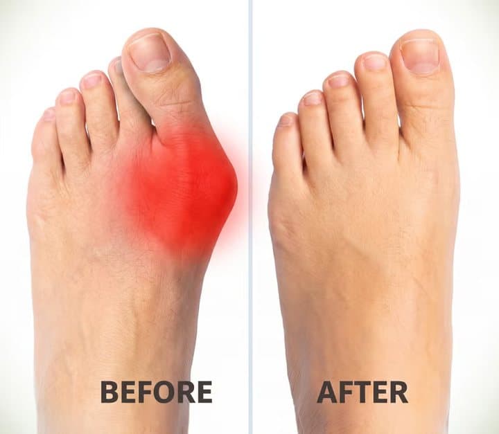 Before and after illustration of a red, swollen bunion and a straighter foot, from the Treatmedy page