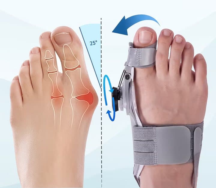 Illustration of a bunion foot next to a foot wearing the Treatmedy splint with an arrow showing the toe pulled 25 degrees