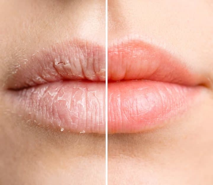 Split close-up of dry, cracked lips beside smooth, hydrated lips, from the Ugly Sleep Club page