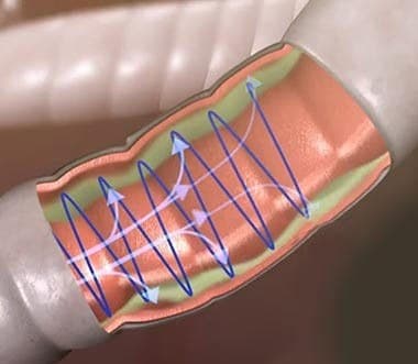 Illustration of an airway with arrows showing vibrations moving along its wall, from the AirPhysio sales page