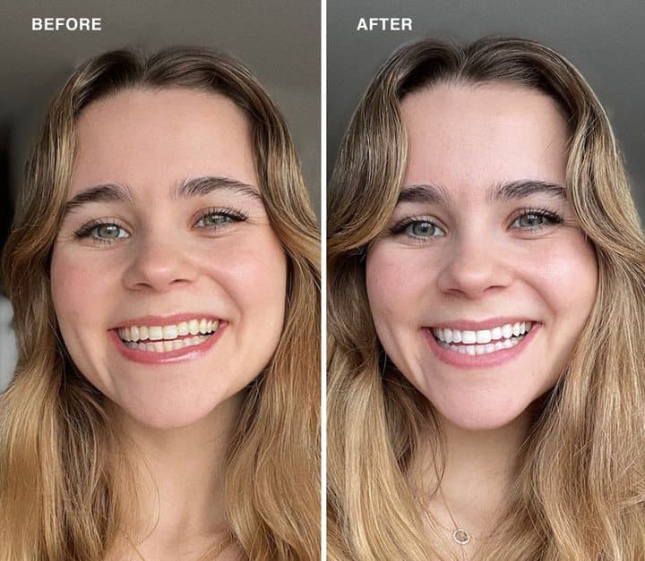 Before and after photos of a woman's smile from the Laughland offer page