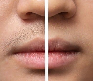 Split image of an upper lip with fine hair on one side and smooth skin on the other