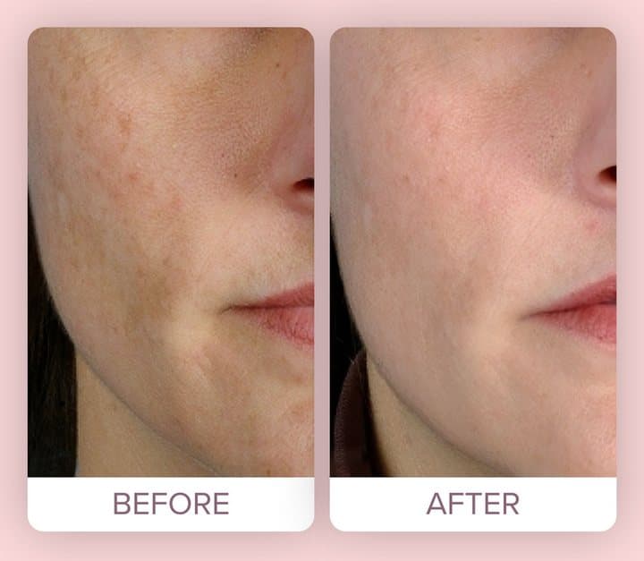Seller's before and after close-up of cheek skin texture