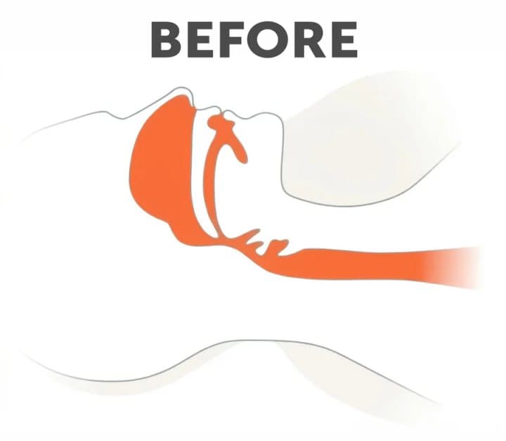 Before and after diagrams of a head showing a blocked airway in red and an open airway in green with a mouthpiece fitted