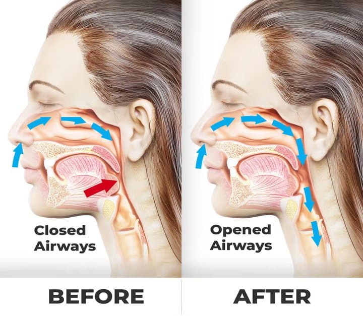 Before and after diagram of a head showing a closed airway and an opened airway, from SnoreStop