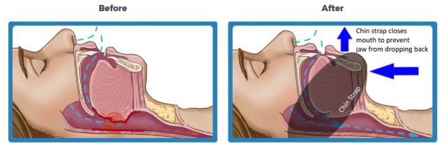 How SnoreStrap Design Stops Snoring