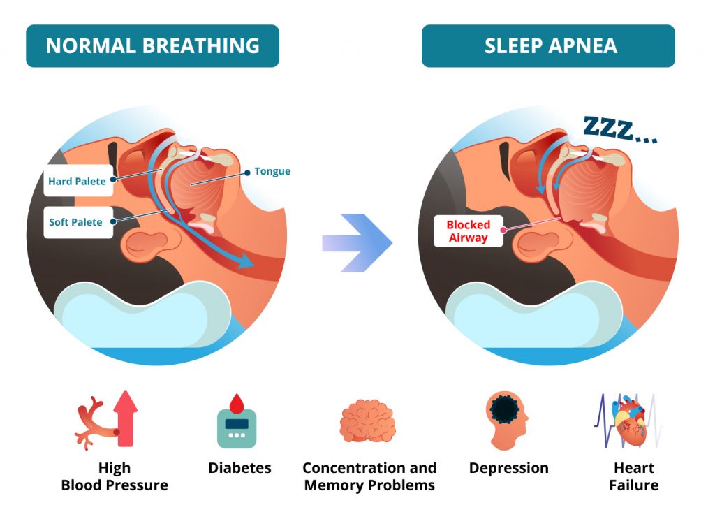 Living Snore-Free Actually Possible