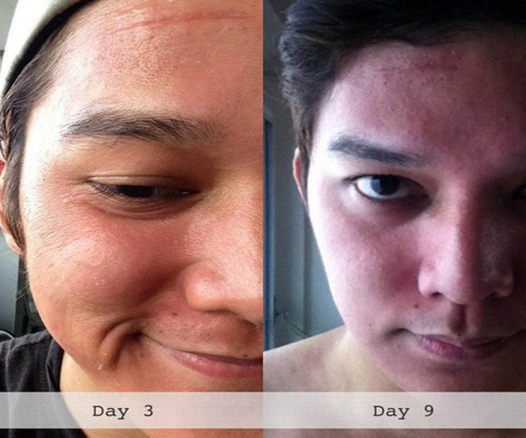 iSkin Review - New Facial Peeling Device 5 iSkin Review - New Facial Peeling Device 2