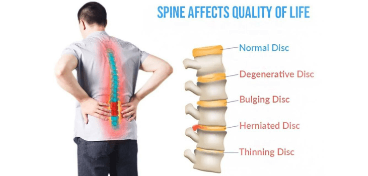 LumbarCorrect Review 2023 - Best Trending Posture Correction Belt It's True? 5 How does LumbarCorrect Work