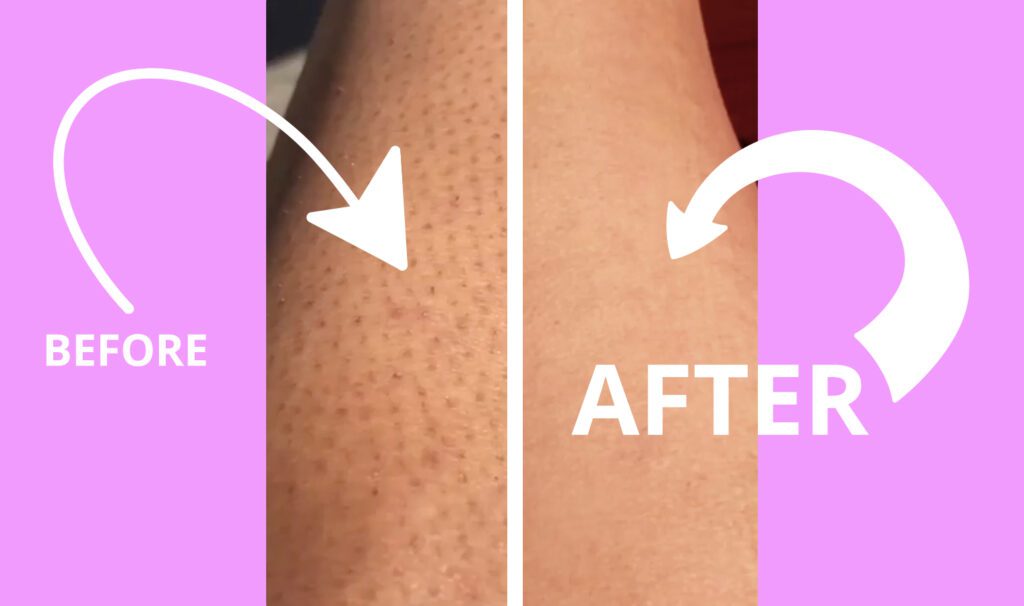 Bleame Hair Eraser Review: Does It Really Work? 3 Before and after Results after using Bleame Hair Eraser Tool