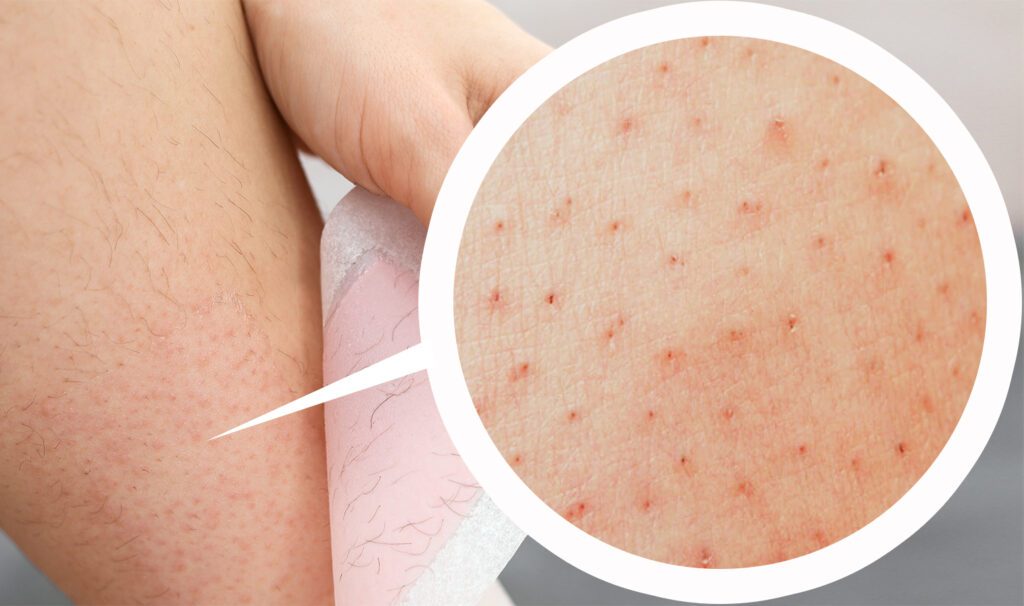 Best Crystal Hair Eraser: Buying Guide 7 Ingrown hair
